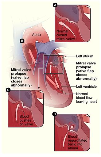 Mitral Valve Prolaspse & Regurgitation