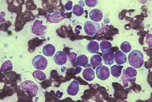 Cancerous Lymphoblasts