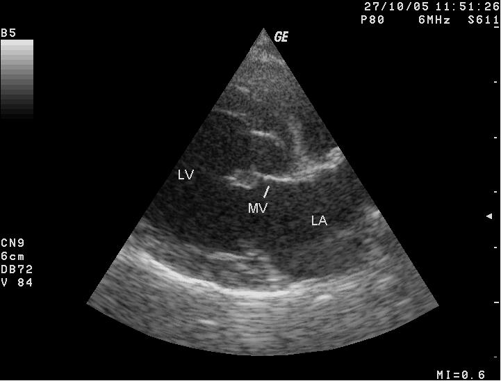 Chronic degenerative valvular disease in a dog, heart, echocardiogram, right parasternal long-axis view; LA-left atrium; LV-left ventricle; MV-mitral valve, septal leaflet. Note the thickened free end of the mitral valve leaflet.
