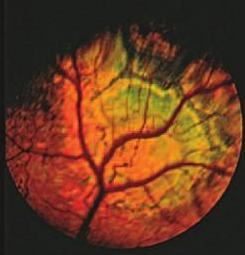 Cavalier King Charles Spaniel with Geographic Retinal Dysplasia
