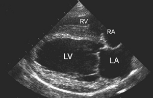 Left ventricle on echo