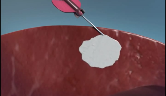 Injecting Alginate Hydrogel into Heart