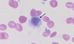 Macrothrombocytopenia