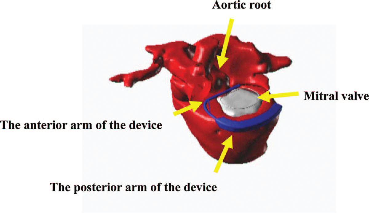 Miitral Touch device implanted on heart
