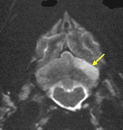 MRI showing wedge shaped cerebellar infarct
