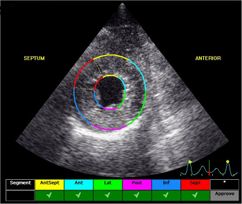 Speckle-Tracking Echocardiography