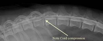 Compressed Spinal Cord