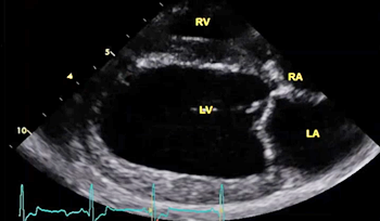 Echo of heart chambers