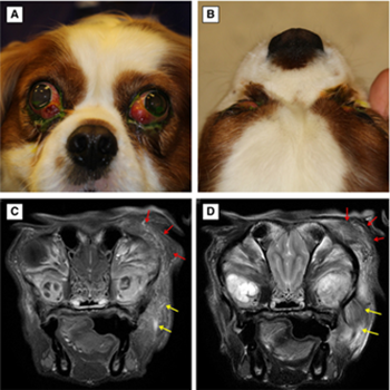 bilateral zygomatic sialadenitis